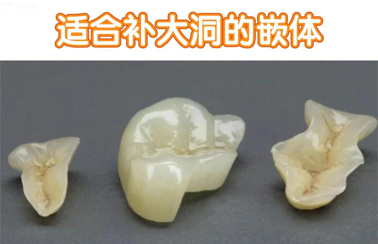 贵金属嵌体(金属嵌体常见材质)