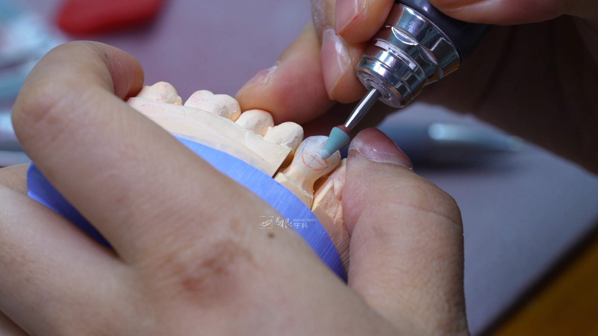 贵金属烤瓷冠(贵金属烤瓷冠金属基底厚度)