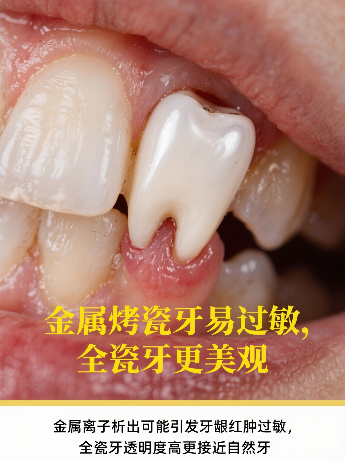 贵金属烤瓷冠(贵金属烤瓷牙多少钱)