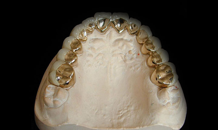 贵金属牙桩(贵金属牙桩会不会断裂) 贵金属牙桩(贵金属牙桩会不会断裂)