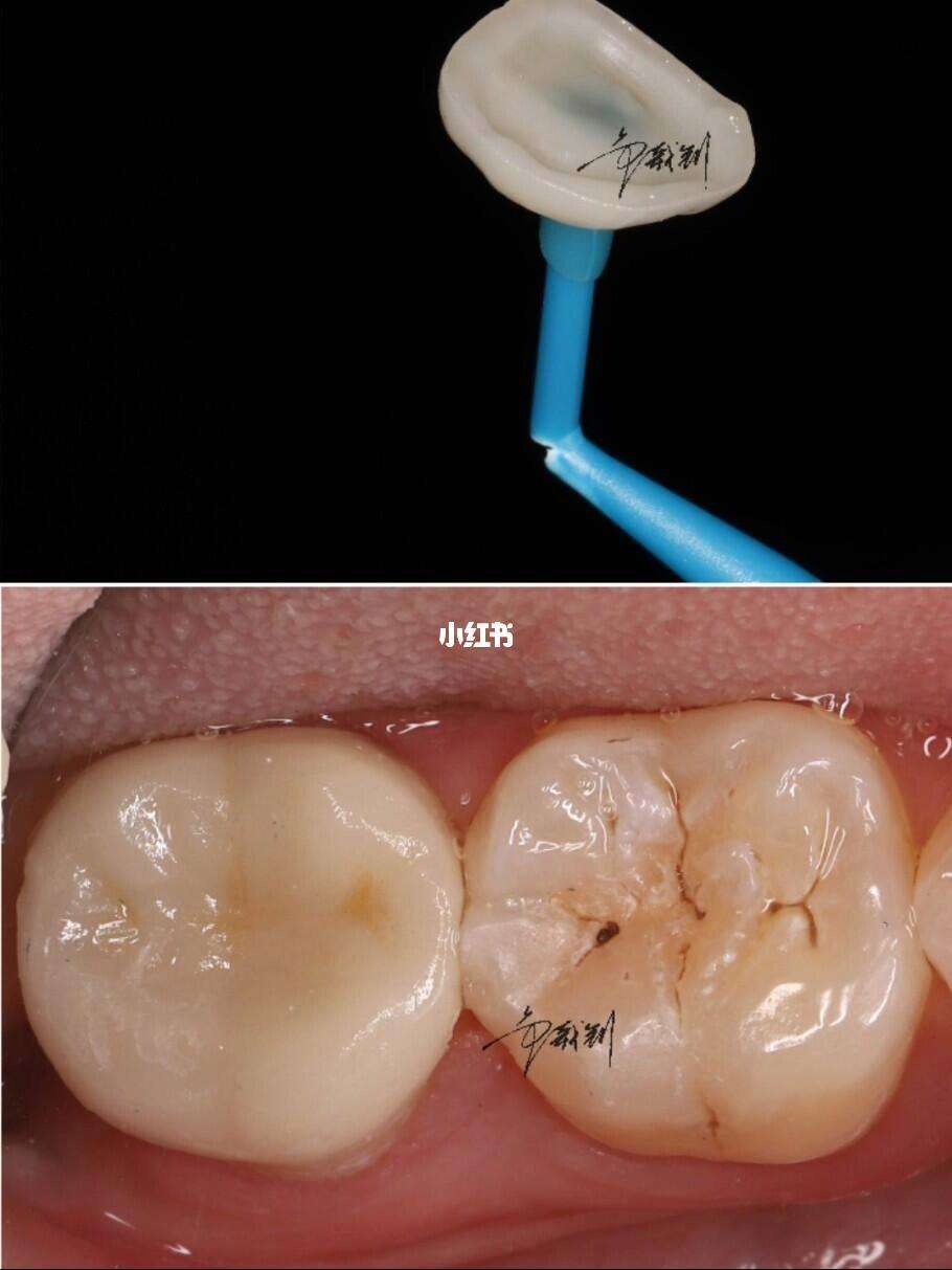 贵金属嵌体(金属嵌体价格)
