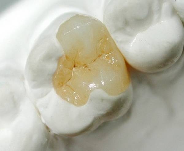 贵金属嵌体(金属嵌体价格)