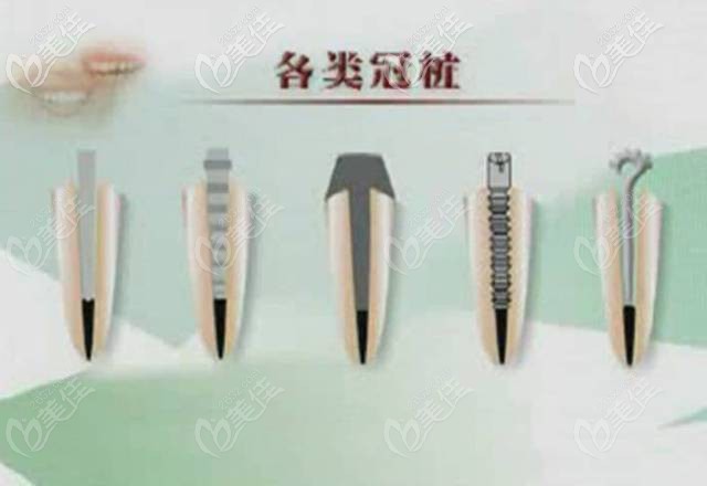 贵金属牙桩(金属牙桩一般有什么材料)