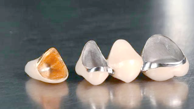 贵金属牙桩(贵金属牙桩的分类)